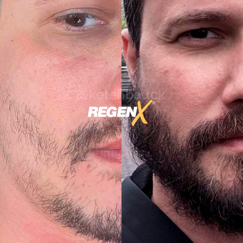 Barbe : avant / après