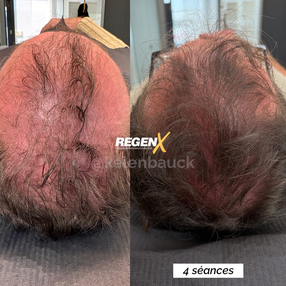 Cuir chevelu : avant / après